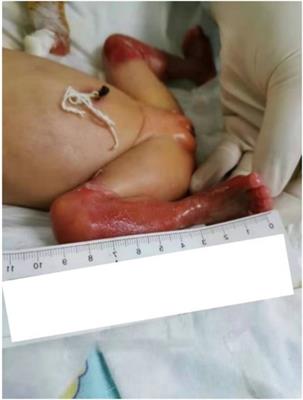 Case report: A case of epidermolysis bullosa complicated with pyloric atresia and a literature review